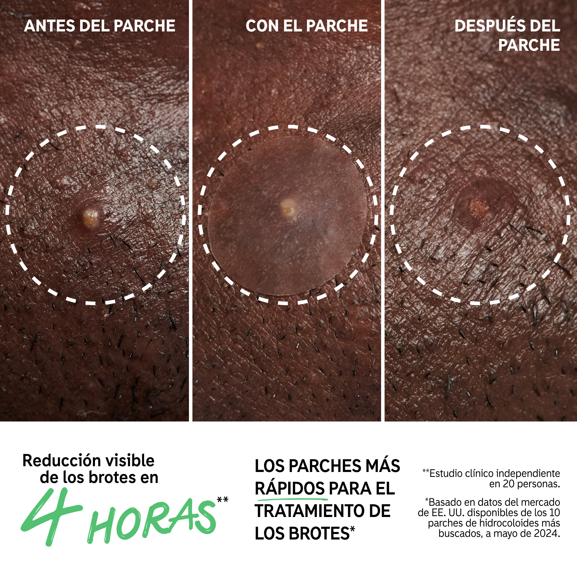 HYDROCOLLOID INVISIBLE PIMPLE PATCHES (PARCHES INVISIBLES PARA ACNÉ)